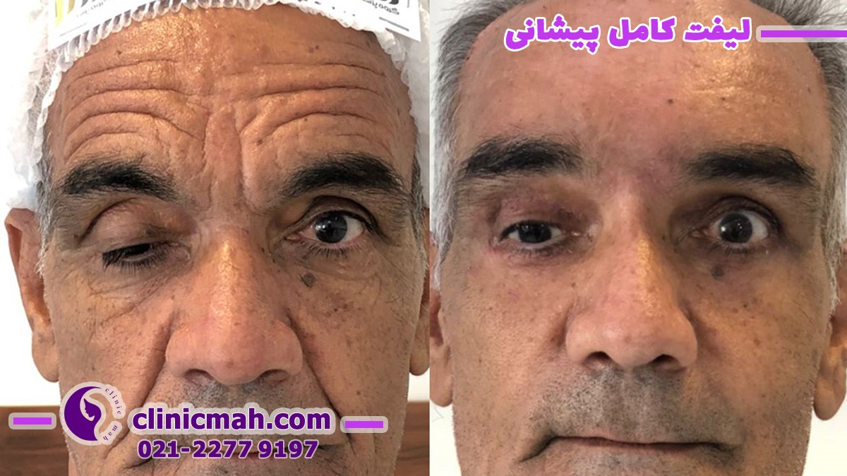 هزینه تزریق چربی