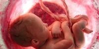 پره اکلامپسی یا مسمومیت بارداری چیست و چه زمانی شروع میشود؟