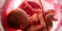 پره اکلامپسی یا مسمومیت بارداری چیست و چه زمانی شروع میشود؟