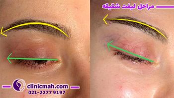 مراقبت های لازم بعد از عمل لیفت شقیقه