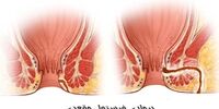 فیستول مقعدی چیست و چگونه در یک روز آن را درمان کنیم؟