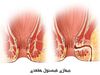 فیستول مقعدی چیست و چگونه در یک روز آن را درمان کنیم؟