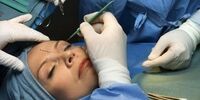 هزینه های جراحی لیفت صورت چقدر است؟ به چه عواملی بستگی دارد؟